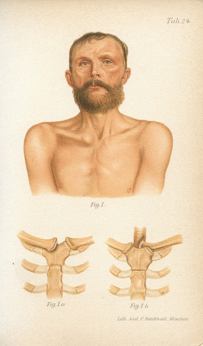 Atlas-manuel des fractures et luxations. Deuxième édition française refondue et augmentée par le Docteur Paul Delbet. Avec 68 planches chromolithographiées entièrement refaites et 137 figures dans le texte. 