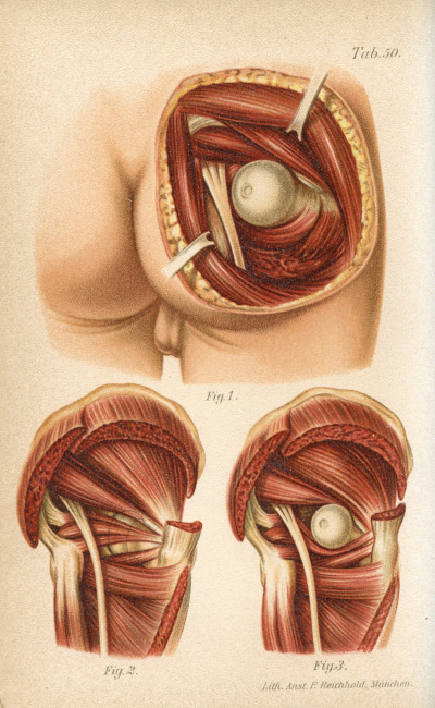 Atlas-manuel des fractures et luxations. Deuxième édition française refondue et augmentée par le Docteur Paul Delbet. Avec 68 planches chromolithographiées entièrement refaites et 137 figures dans le texte. 